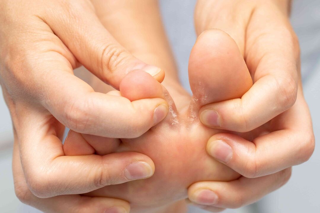 champignon entre les doigts des pieds et son traitement avec la crème Demyxil