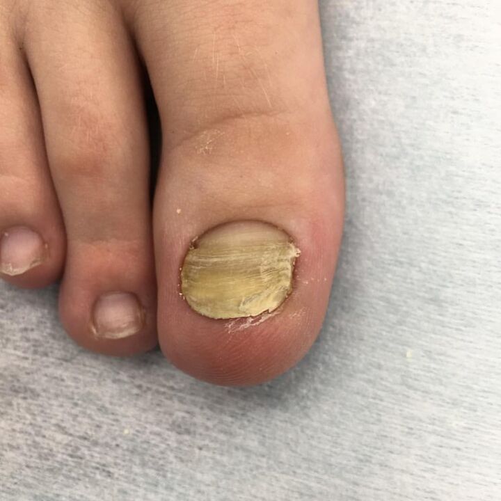 Infection avec un champignon