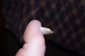 Symptômes de champignon de clou