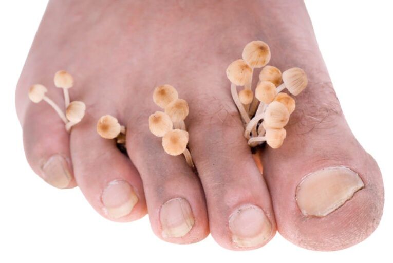 Symptômes de champignon de jambe
