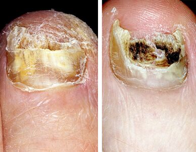 Destruction totale des ongles sur les jambes