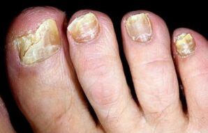 symptômes de la mycose des ongles des pieds